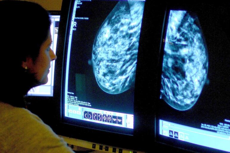 Breast cancer cases and deaths set to rise dramatically by 2050 data suggests