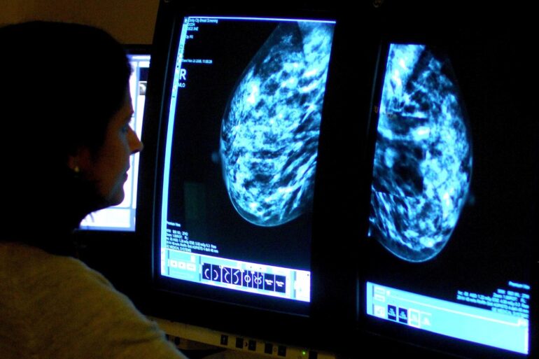 Record number of women up to date with breast screening figures show