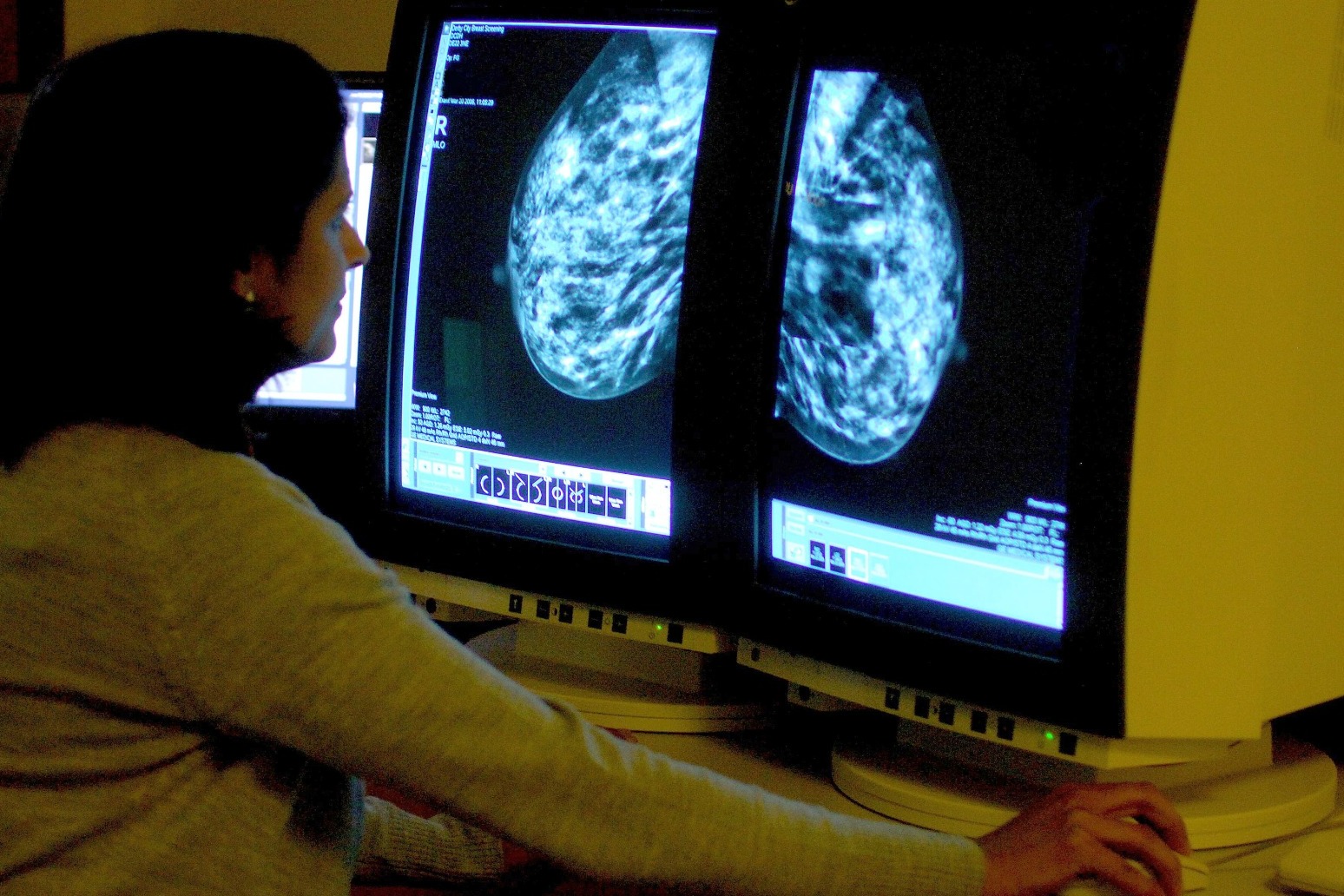 197000 UK lives saved thanks to breast cancer advances