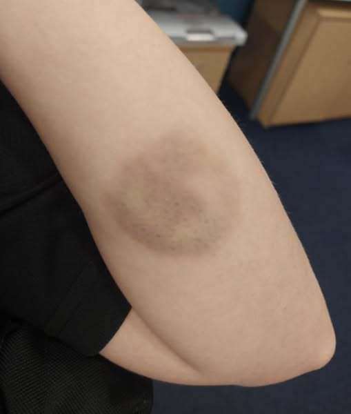 The bite left bruising on the police officer's arm. Pictures: West Norfolk Police